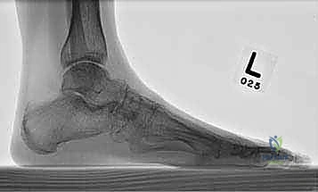 تثبيت شريحة ثانية لزيادة الاستقرار