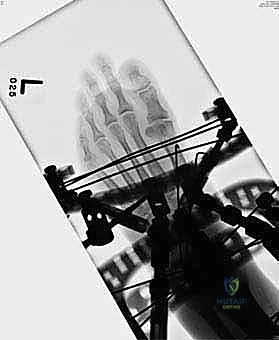 صورة طبية: تثبيت مفصل منتصف القدم: حل دائم لتشوهات القدم المعقدة واستعادة الحركة