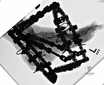 صورة طبية: تثبيت مفصل منتصف القدم: حل دائم لتشوهات القدم المعقدة واستعادة الحركة