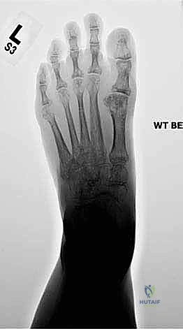 إدخال المسمار الأول للتثبيت المبدئي