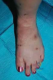 صورة طبية: تثبيت مفصل منتصف القدم: حل دائم لتشوهات القدم المعقدة واستعادة الحركة