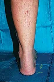 صورة طبية: تثبيت مفصل منتصف القدم: حل دائم لتشوهات القدم المعقدة واستعادة الحركة