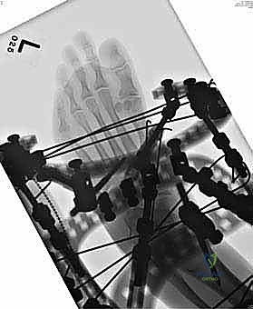 صورة توضيحية لـ تثبيت مفصل منتصف القدم: حل دائم لتشوهات القدم المعقدة واستعادة الحركة