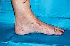 صورة طبية: تثبيت مفصل منتصف القدم: حل دائم لتشوهات القدم المعقدة واستعادة الحركة