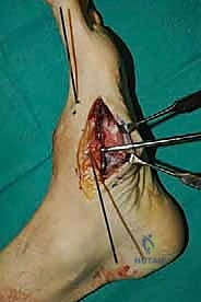 صورة طبية: تثبيت مفصل منتصف القدم: حل دائم لتشوهات القدم المعقدة واستعادة الحركة