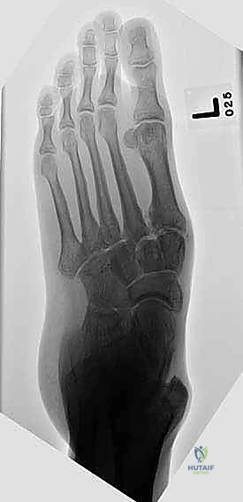 التحضير لدمج العظام