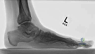 صورة طبية: تثبيت مفصل منتصف القدم: حل دائم لتشوهات القدم المعقدة واستعادة الحركة