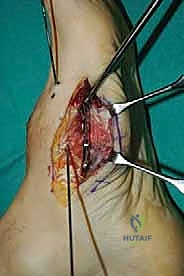 صورة طبية: تثبيت مفصل منتصف القدم: حل دائم لتشوهات القدم المعقدة واستعادة الحركة