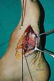 صورة طبية: تثبيت مفصل منتصف القدم: حل دائم لتشوهات القدم المعقدة واستعادة الحركة