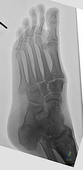 التحقق من استعادة قوس القدم