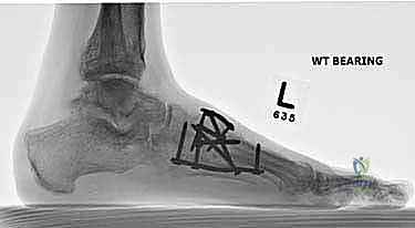 صورة طبية: تثبيت مفصل منتصف القدم: حل دائم لتشوهات القدم المعقدة واستعادة الحركة