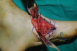 صورة طبية: تثبيت مفصل منتصف القدم: حل دائم لتشوهات القدم المعقدة واستعادة الحركة