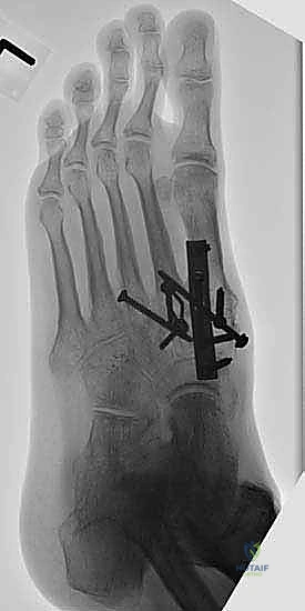 تشكيل الشريحة لتناسب تشريح القدم