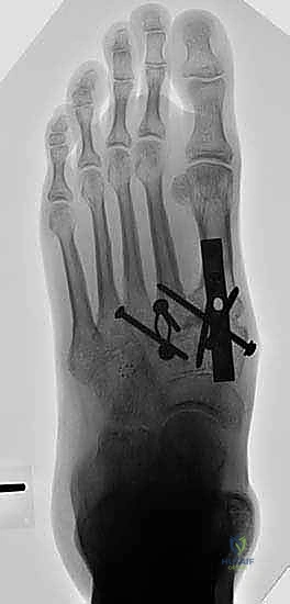 صورة شعاعية للتثبيت أثناء العملية