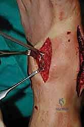 صورة طبية: تثبيت مفصل منتصف القدم: حل دائم لتشوهات القدم المعقدة واستعادة الحركة