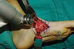 صورة توضيحية لـ تثبيت مفصل منتصف القدم: حل دائم لتشوهات القدم المعقدة واستعادة الحركة