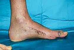 صورة طبية: تثبيت مفصل منتصف القدم: حل دائم لتشوهات القدم المعقدة واستعادة الحركة