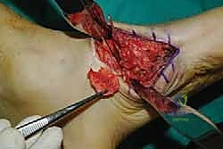 صورة طبية: تثبيت مفصل منتصف القدم: حل دائم لتشوهات القدم المعقدة واستعادة الحركة