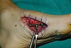 صورة شعاعية نهائية للشرائح والمسامير