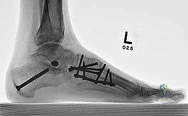 صورة طبية: تثبيت مفصل منتصف القدم: حل دائم لتشوهات القدم المعقدة واستعادة الحركة