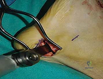 صورة طبية: تثبيت مفصل منتصف القدم: حل دائم لتشوهات القدم المعقدة واستعادة الحركة