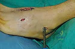 صورة طبية: تثبيت مفصل منتصف القدم: حل دائم لتشوهات القدم المعقدة واستعادة الحركة