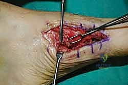 صورة طبية: تثبيت مفصل منتصف القدم: حل دائم لتشوهات القدم المعقدة واستعادة الحركة