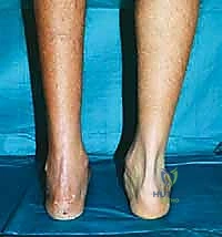 صورة طبية: تثبيت مفصل منتصف القدم: حل دائم لتشوهات القدم المعقدة واستعادة الحركة