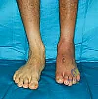 صورة طبية: تثبيت مفصل منتصف القدم: حل دائم لتشوهات القدم المعقدة واستعادة الحركة