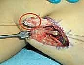 Rectus Femoris Transfer for Stiff-Knee Gait in Cerebral Palsy: An Intraoperative Masterclass