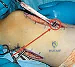 صورة توضيحية لـ نقل العضلة المستقيمة الفخذية لعلاج مشية الركبة المتيبسة في الشلل الدماغي: دليل شامل للمرضى مع الأستاذ الدكتور محمد هطيف