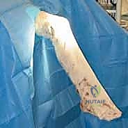 الحزم التشريحية للرباط الصليبي