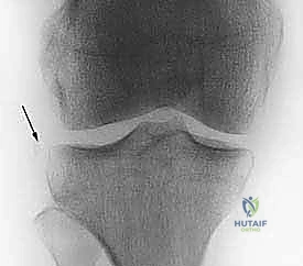تشريح الركبة والرباط الصليبي الأمامي