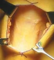 إصابات رياضية تلامسية