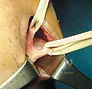 صورة رنين مغناطيسي لتمزق الرباط