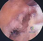 صورة توضيحية لـ إعادة بناء الرباط الصليبي الأمامي: دليلك الشامل لركبة قوية مع الأستاذ الدكتور محمد هطيف