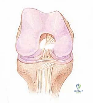 تحضير طعم أوتار المأبض