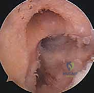 صورة طبية: إعادة بناء الرباط الصليبي الأمامي: دليلك الشامل لركبة قوية مع الأستاذ الدكتور محمد هطيف