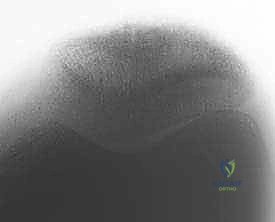 Illustration of singlebundle anterior cruciate ligament - Dr. Mohammed Hutaif