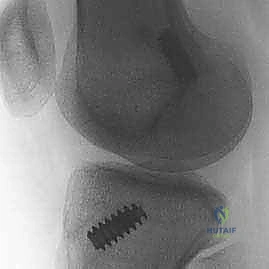 صورة طبية: إعادة بناء الرباط الصليبي الأمامي: دليلك الشامل لركبة قوية مع الأستاذ الدكتور محمد هطيف