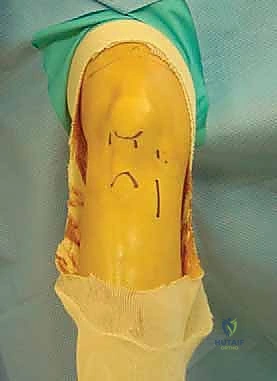 صورة توضيحية لـ إعادة بناء الرباط الصليبي الأمامي المزدوج التشريحي: استعادة كامل وظيفة الركبة مع الأستاذ الدكتور محمد هطيف في صنعاء