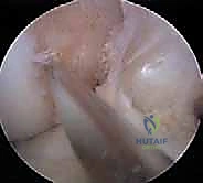 صورة توضيحية لـ إعادة بناء الرباط الصليبي الأمامي المزدوج التشريحي