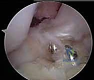 تثبيت الحزم الوترية