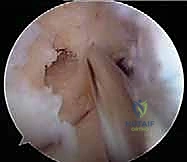 حفر الأنفاق العظمية بدقة