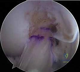 صورة توضيحية لـ إعادة بناء الرباط الصليبي الأمامي المزدوج التشريحي: استعادة كامل وظيفة الركبة مع الأستاذ الدكتور محمد هطيف في صنعاء