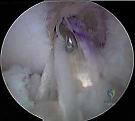 إعادة بناء الرباط الصليبي الأمامي المزدوج التشريحي: استعادة كامل وظيفة الركبة مع الأستاذ الدكتور محمد هطيف في صنعاء