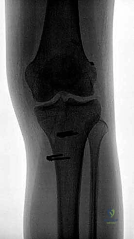 صورة توضيحية لـ إعادة بناء الرباط الصليبي الأمامي المزدوج التشريحي: استعادة كامل وظيفة الركبة مع الأستاذ الدكتور محمد هطيف في صنعاء