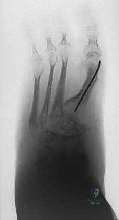 Percutaneous Midfoot Osteotomy with External Fixation: An Intraoperative Masterclass