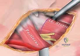 التقييم الشعاعي وقياس نسبة هجرة رأس الفخذ