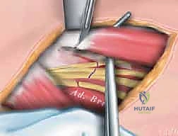 الأعراض السريرية وعلامات خلع الورك التشنجي عند الأطفال